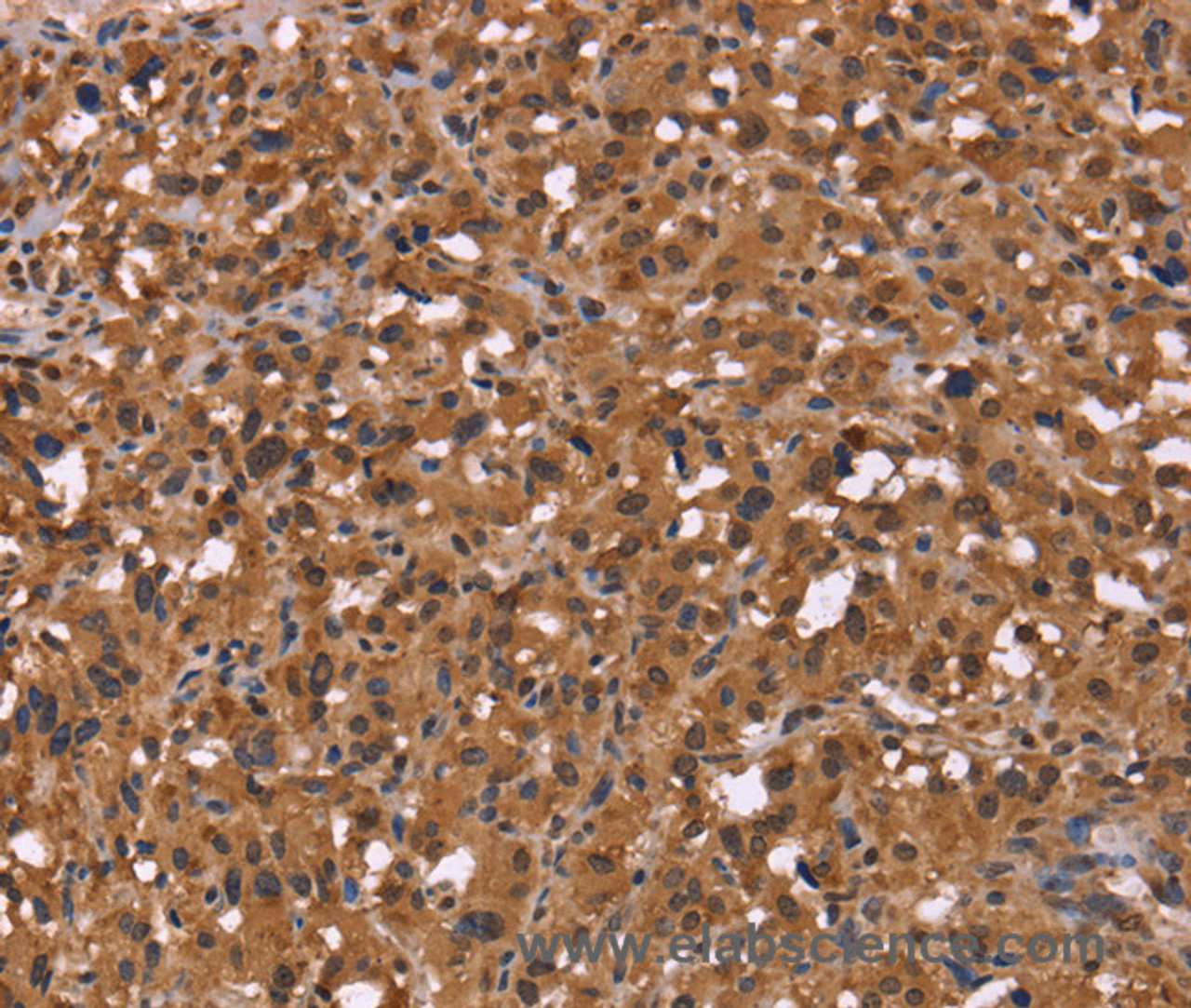 Immunohistochemistry of paraffin-embedded Human thyroid cancer using HDLBP Polyclonal Antibody at dilution of 1:50