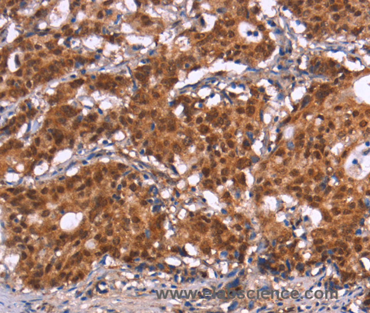 Immunohistochemistry of paraffin-embedded Human gastric cancer tissue using HIPK1 Polyclonal Antibody at dilution 1:30