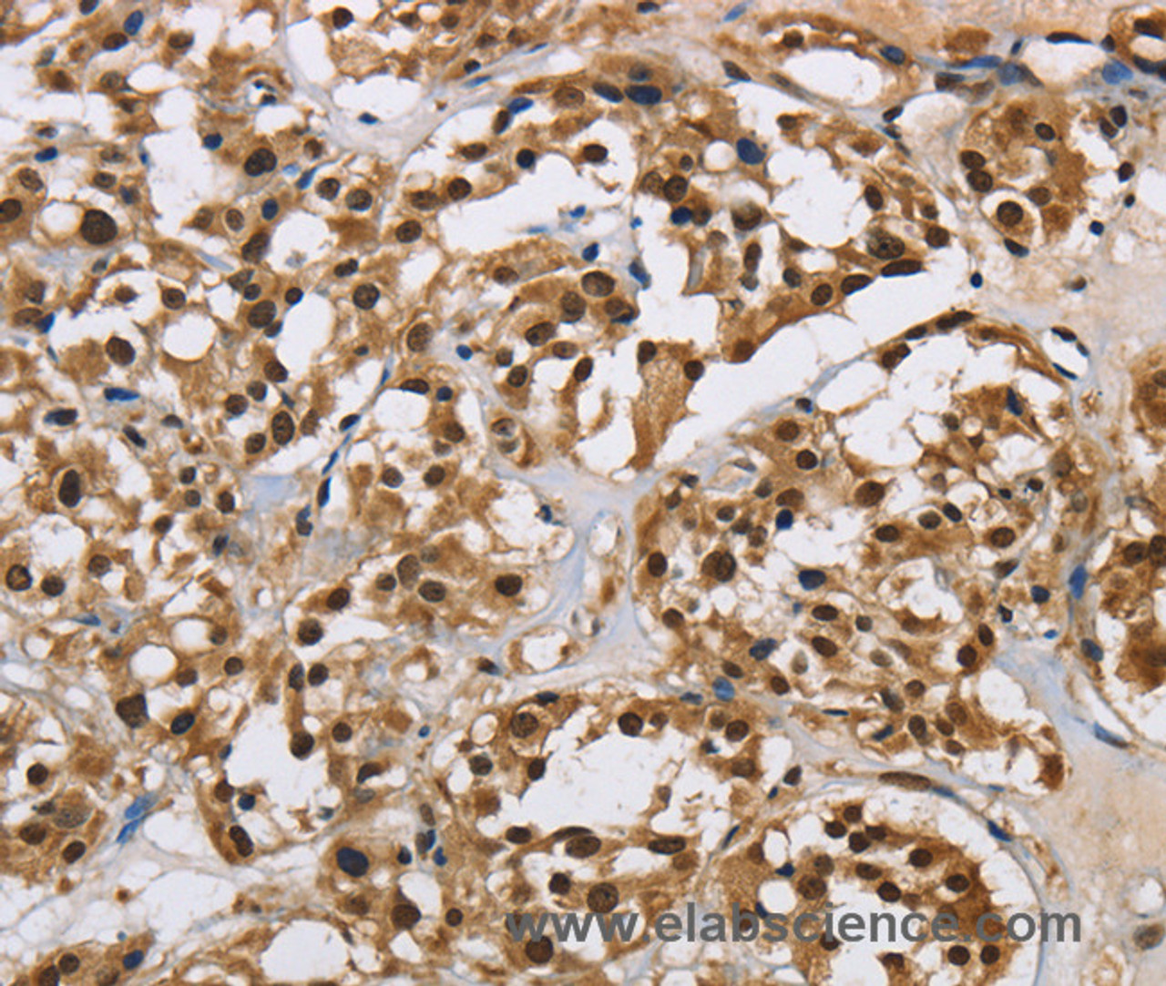 Immunohistochemistry of paraffin-embedded Human thyroid cancer using HNRNP L Polyclonal Antibody at dilution of 1:40