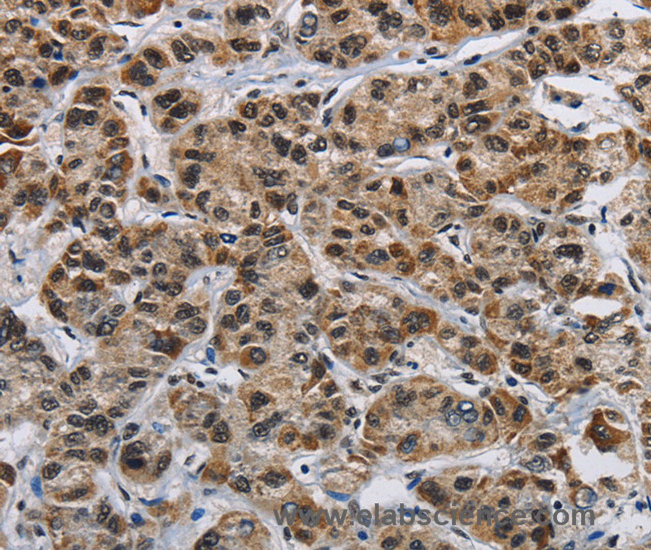Immunohistochemistry of paraffin-embedded Human liver cancer using HNRNP L Polyclonal Antibody at dilution of 1:40