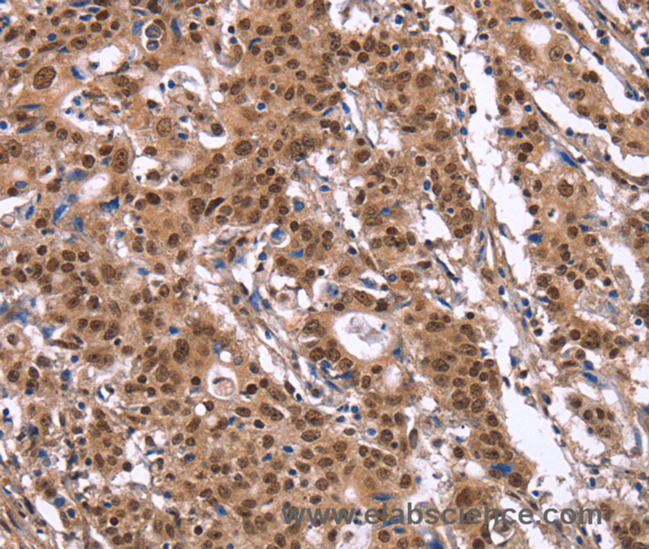 Immunohistochemistry of paraffin-embedded Human gasrtic cancer tissue using ID4 Polyclonal Antibody at dilution 1:40