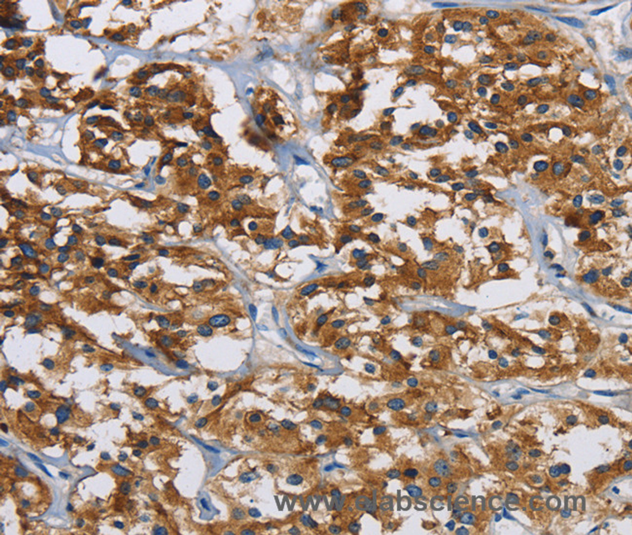Immunohistochemistry of paraffin-embedded Human thyroid cancer tissue using IGF2R Polyclonal Antibody at dilution 1:40