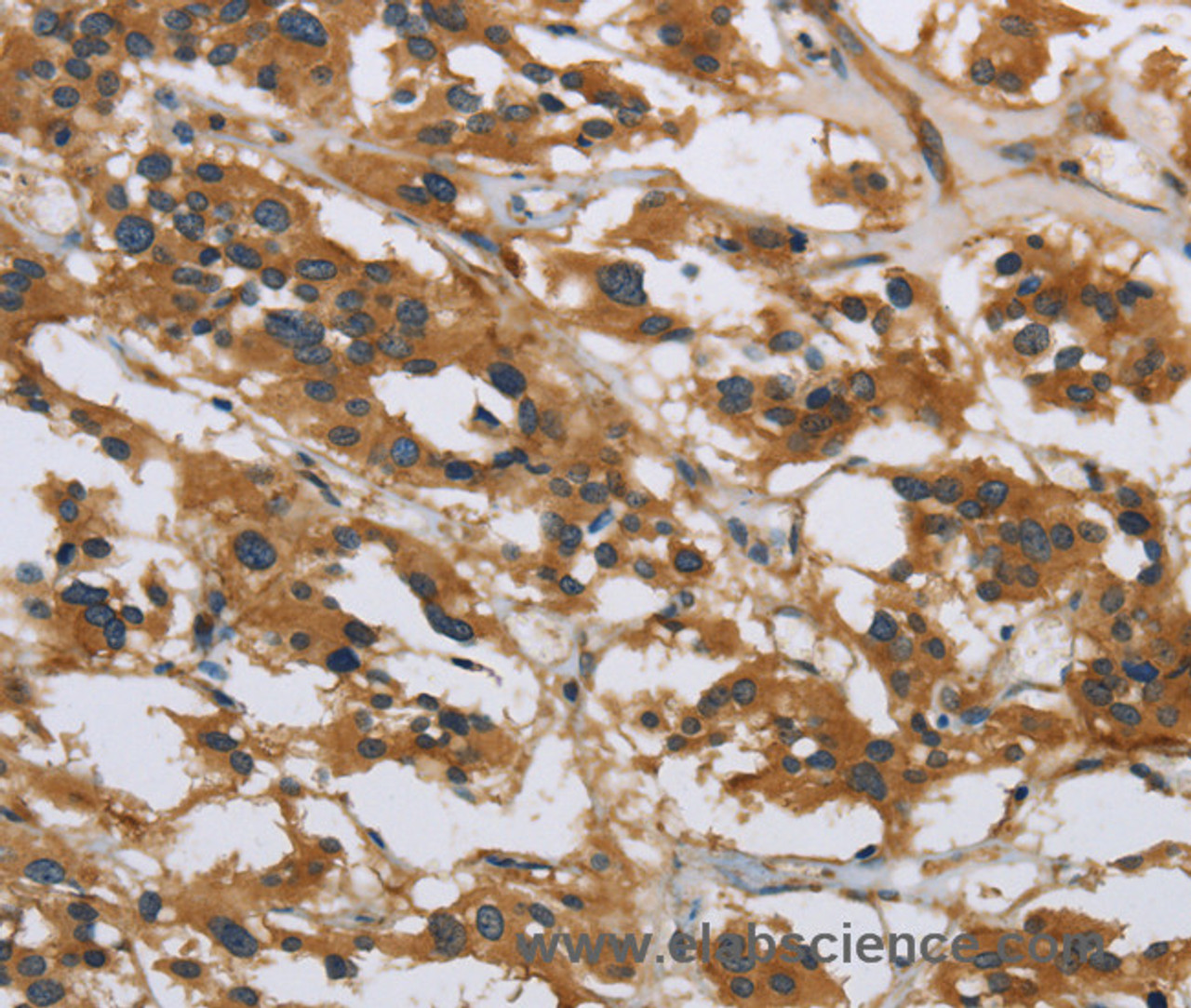 Immunohistochemistry of paraffin-embedded Human thyroid cancer using IL5RA Polyclonal Antibody at dilution of 1:40