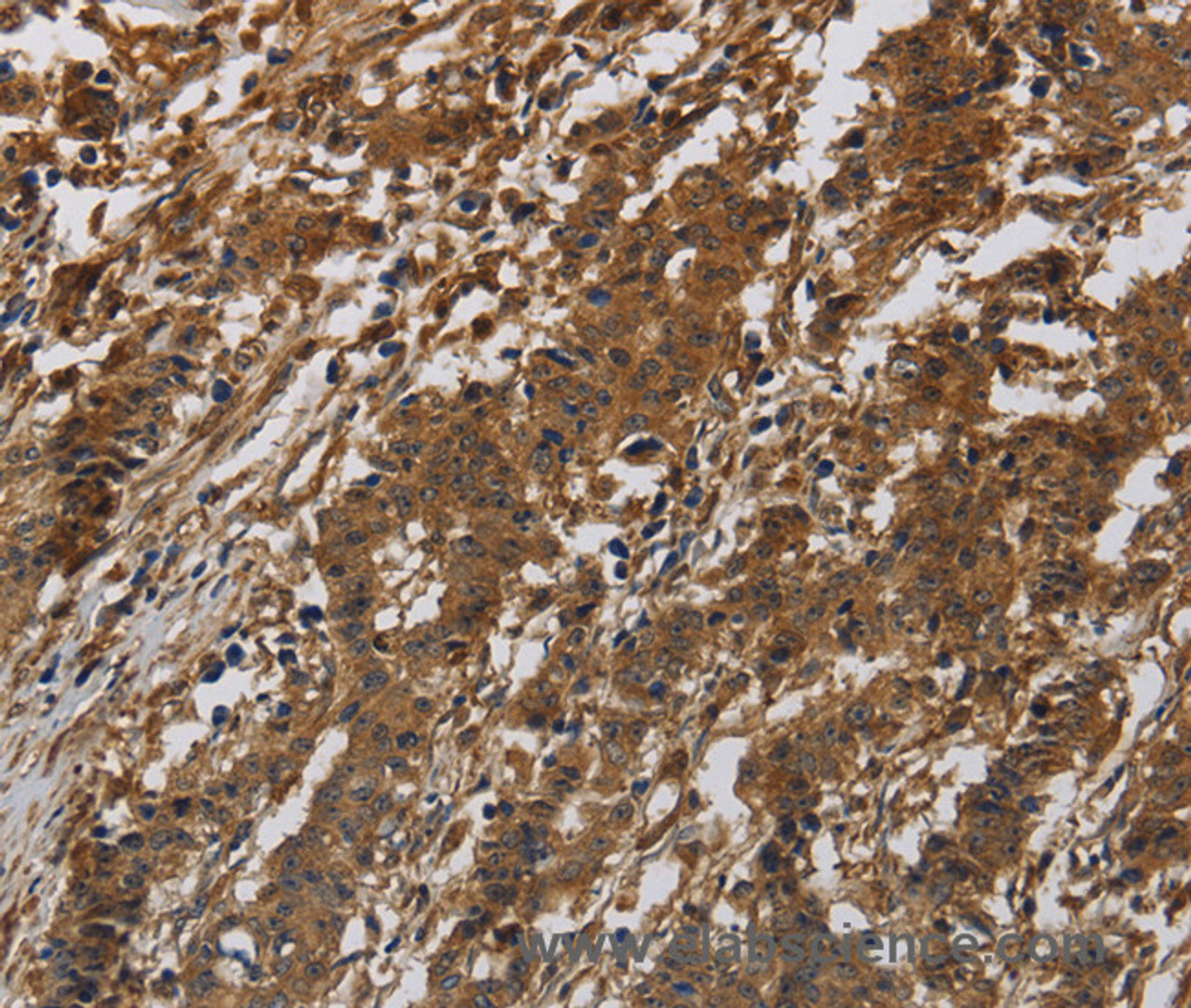 Immunohistochemistry of paraffin-embedded Human liver cancer tissue using ITGB7 Polyclonal Antibody at dilution of 1:40