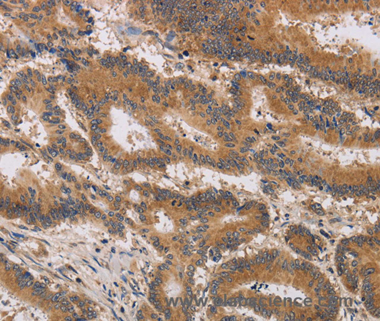 Immunohistochemistry of paraffin-embedded Human colon cancer tissue using ITIH1 Polyclonal Antibody at dilution of 1:30