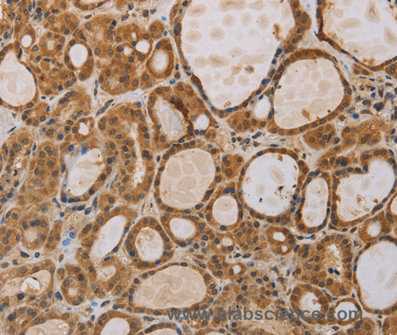 Immunohistochemistry of paraffin-embedded Human thyroid cancer using ITIH1 Polyclonal Antibody at dilution of 1:30