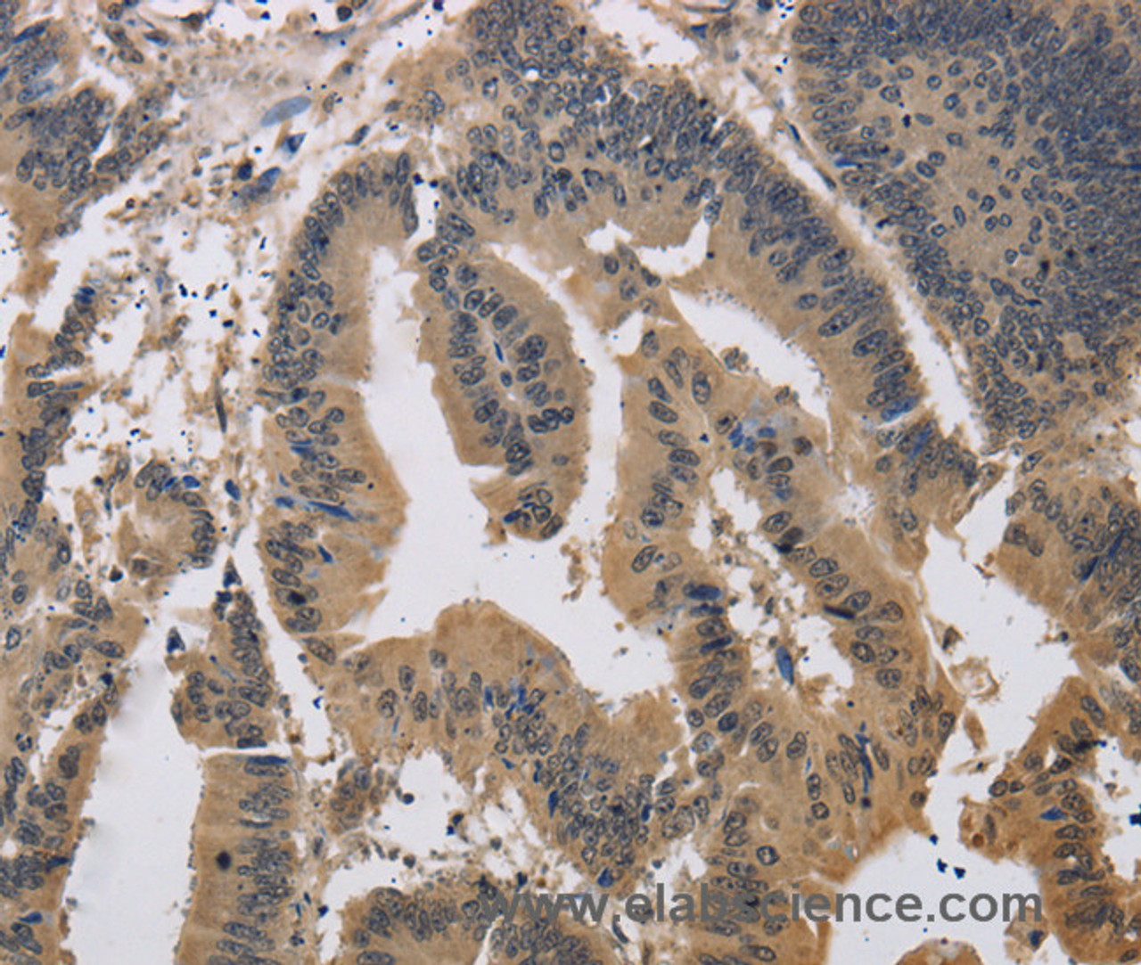 Immunohistochemistry of paraffin-embedded Human colon cancer tissue using JAG1 Polyclonal Antibody at dilution 1:40