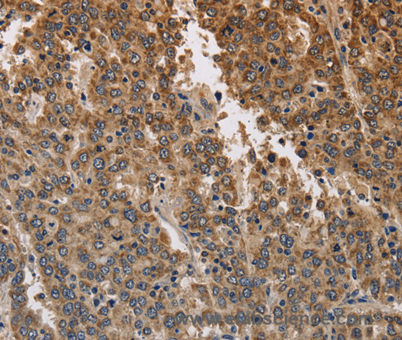 Immunohistochemistry of paraffin-embedded Human liver cancer using KCNK9 Polyclonal Antibody at dilution of 1:40