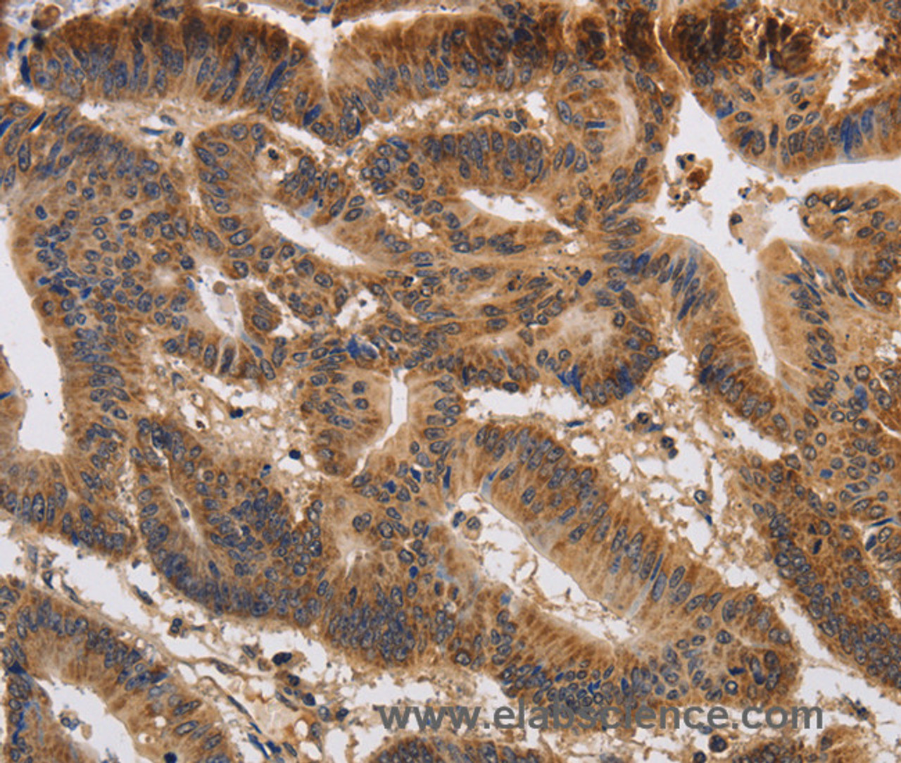 Immunohistochemistry of paraffin-embedded Human colon cancer using KCNK9 Polyclonal Antibody at dilution of 1:40