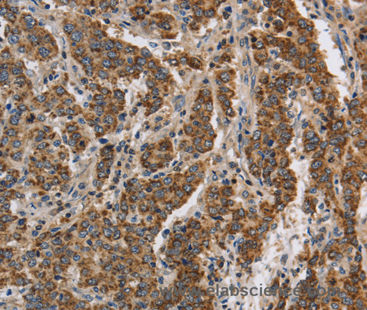 Immunohistochemistry of paraffin-embedded Human liver cancer using KCNQ4 Polyclonal Antibody at dilution of 1:40