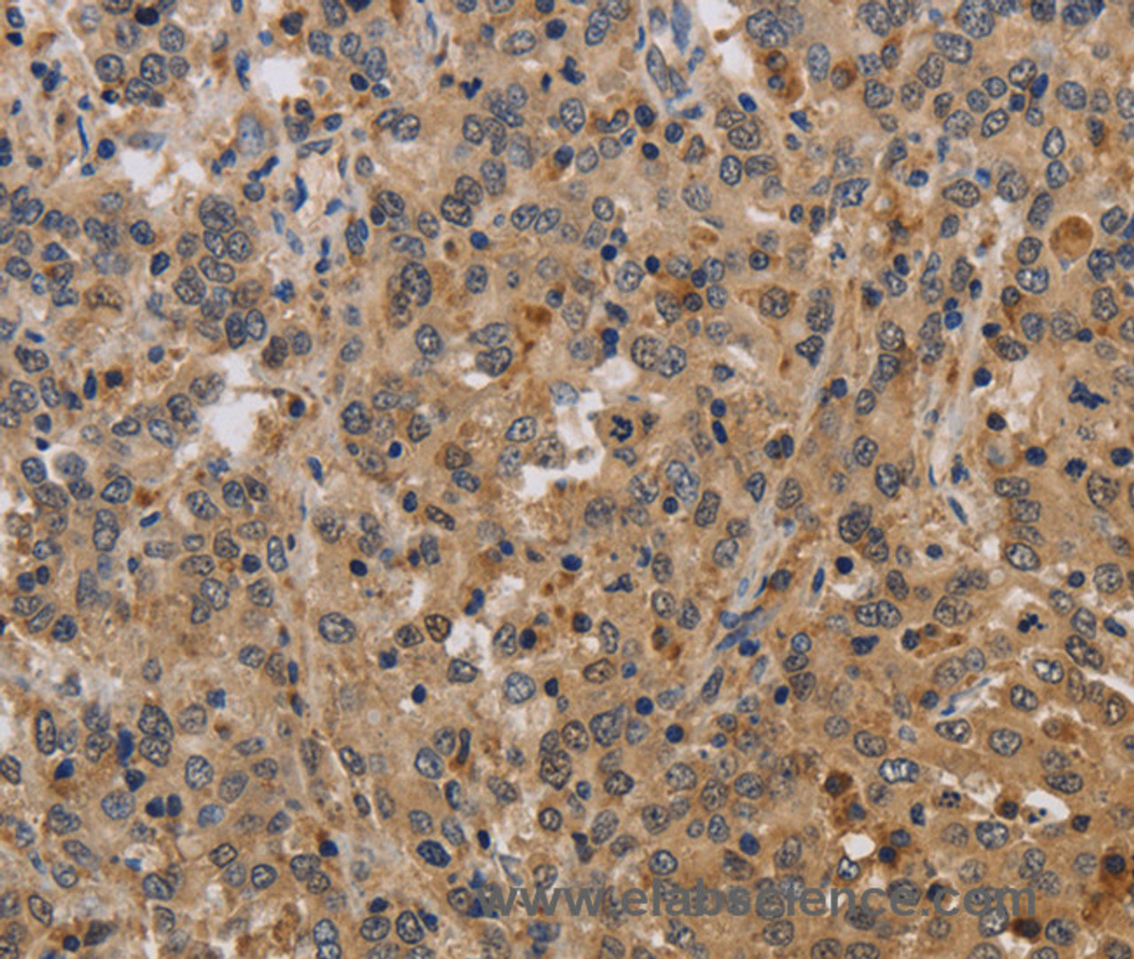 Immunohistochemistry of paraffin-embedded Human liver cancer tissue using ELAVL2 Polyclonal Antibody at dilution 1:40