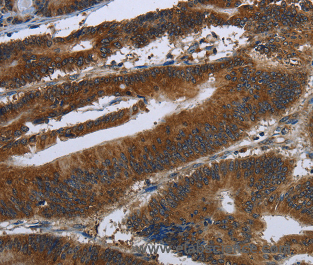 Immunohistochemistry of paraffin-embedded Human colon cancer tissue using ARHGEF12 Polyclonal Antibody at dilution 1:30