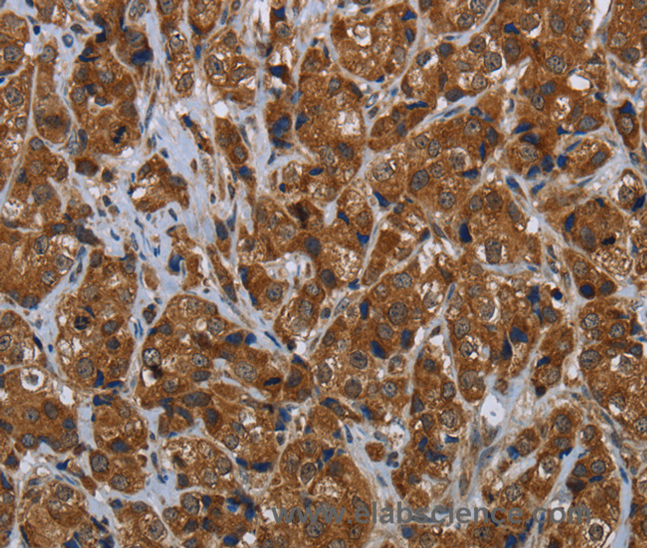 Immunohistochemistry of paraffin-embedded Human breast cancer tissue using ARHGEF12 Polyclonal Antibody at dilution 1:30
