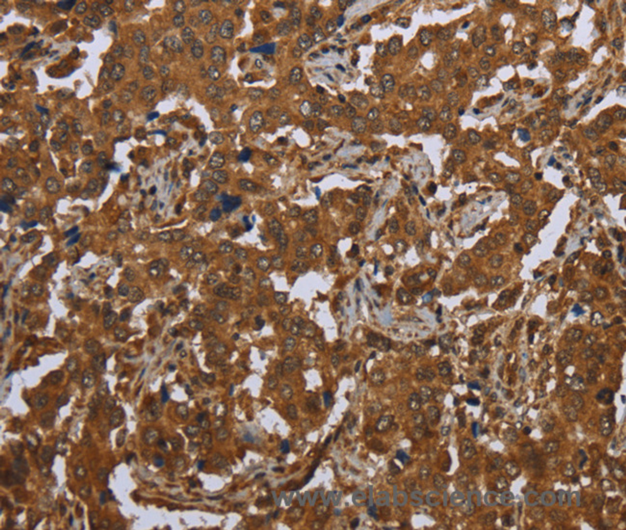 Immunohistochemistry of paraffin-embedded Human liver cancer tissue using SCGB1D2 Polyclonal Antibody at dilution 1:40