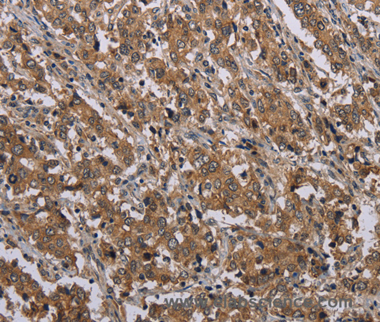 Immunohistochemistry of paraffin-embedded Human liver cancer tissue using MAL Polyclonal Antibody at dilution 1:30