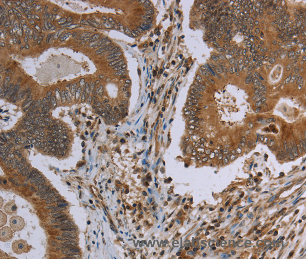 Immunohistochemistry of paraffin-embedded Human colon cancer using MAVS Polyclonal Antibody at dilution of 1:30