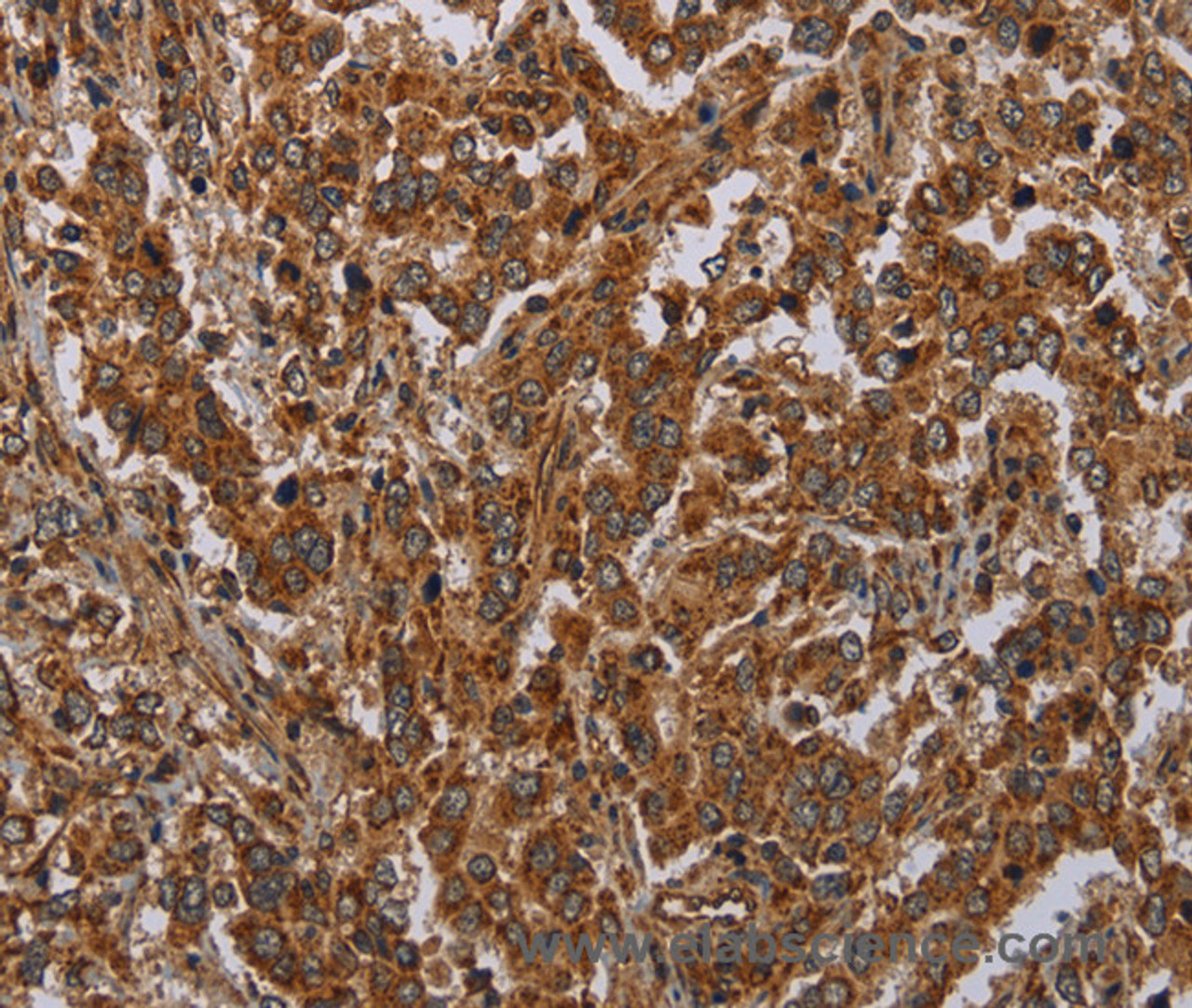 Immunohistochemistry of paraffin-embedded Human liver cancer tissue using ATP2A1 Polyclonal Antibody at dilution 1:30