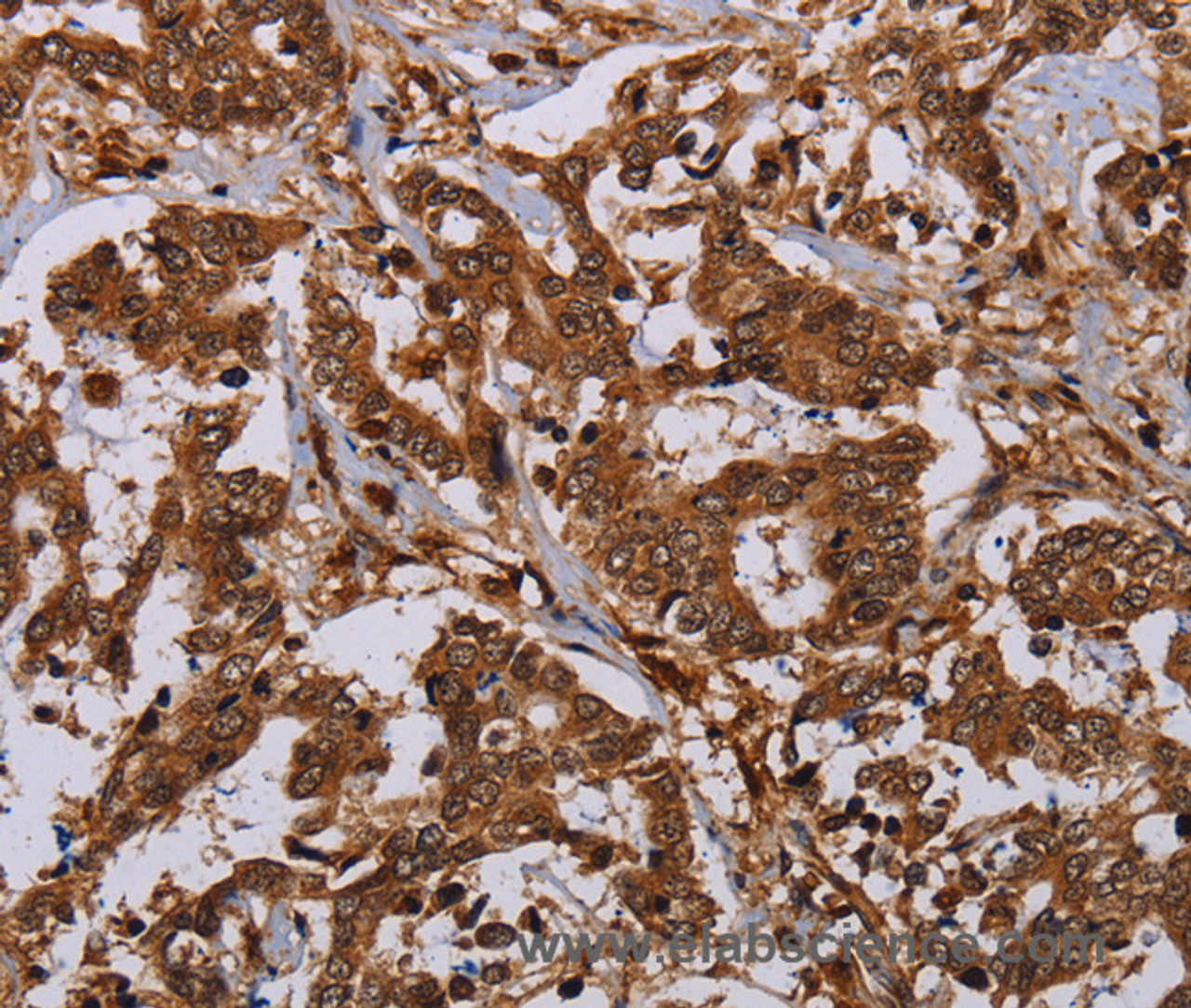 Immunohistochemistry of paraffin-embedded Human liver cancer using MOB1A Polyclonal Antibody at dilution of 1:30