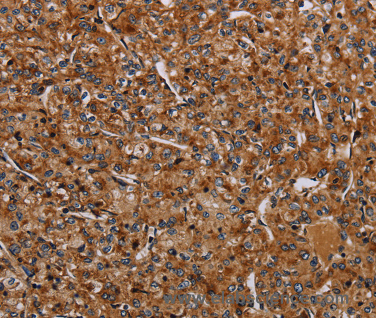 Immunohistochemistry of paraffin-embedded Human prostate cancer using NDUFA8 Polyclonal Antibody at dilution of 1:40