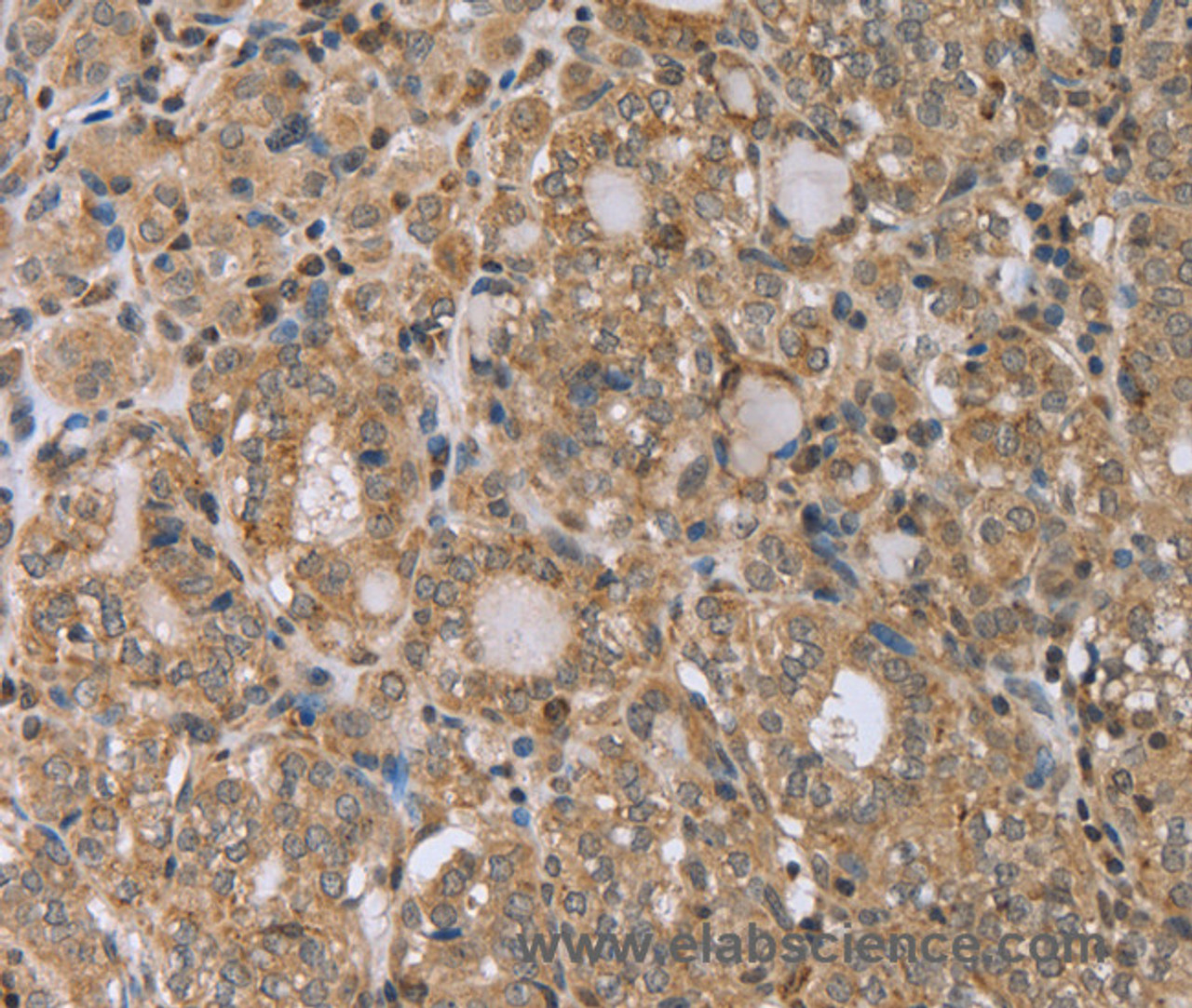 Immunohistochemistry of paraffin-embedded Human thyroid cancer tissue using RAB39B Polyclonal Antibody at dilution 1:45