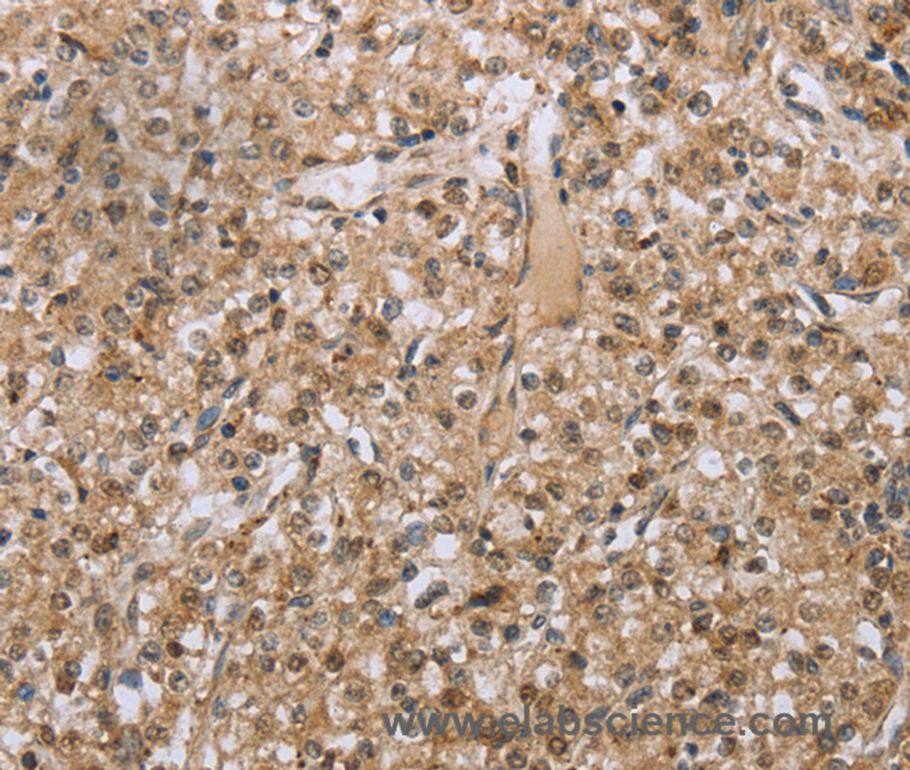 Immunohistochemistry of paraffin-embedded Human prostate cancer tissue using RAB39B Polyclonal Antibody at dilution 1:45