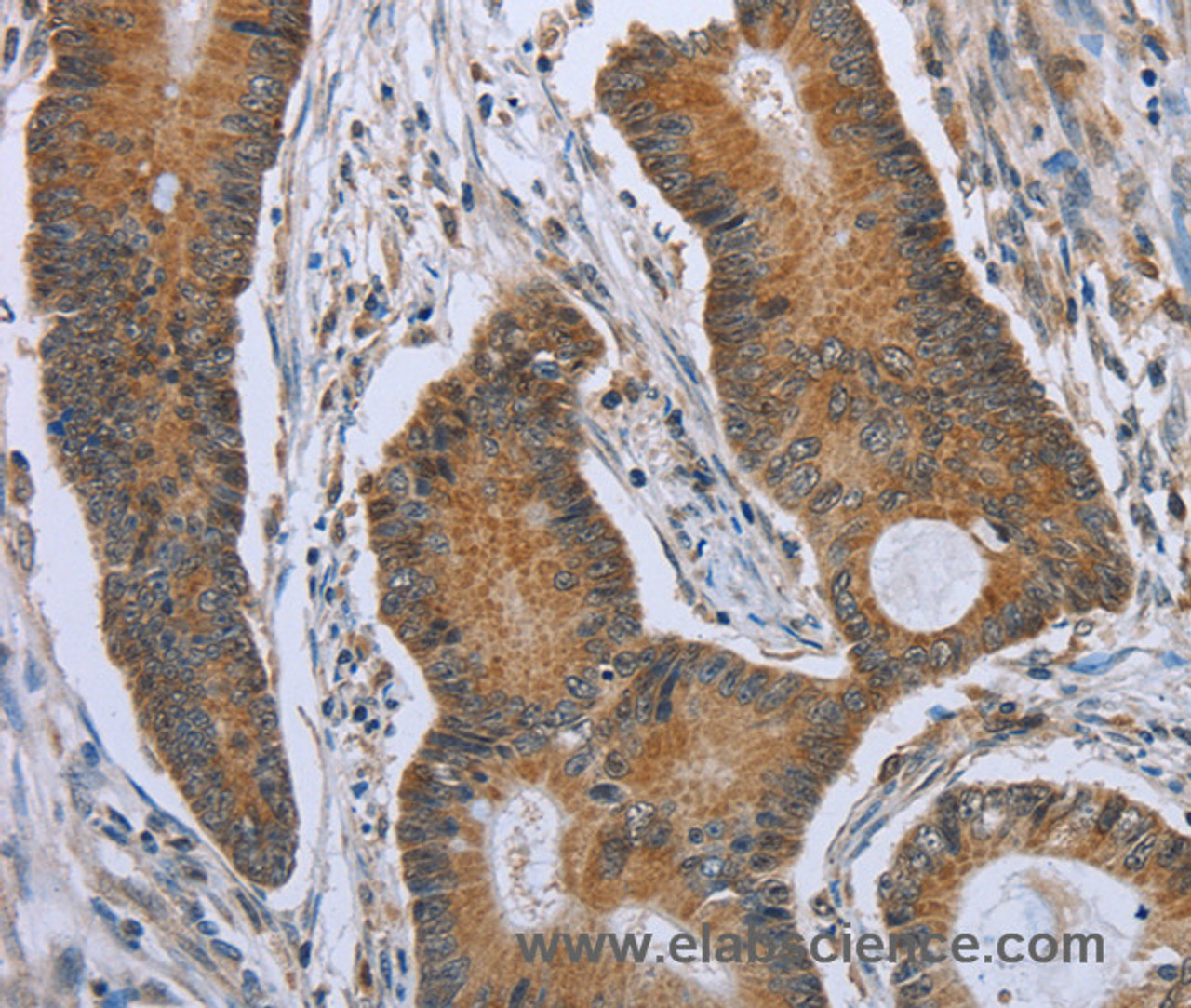 Immunohistochemistry of paraffin-embedded Human colon cancer tissue using TNFRSF13C Polyclonal Antibody at dilution 1:40