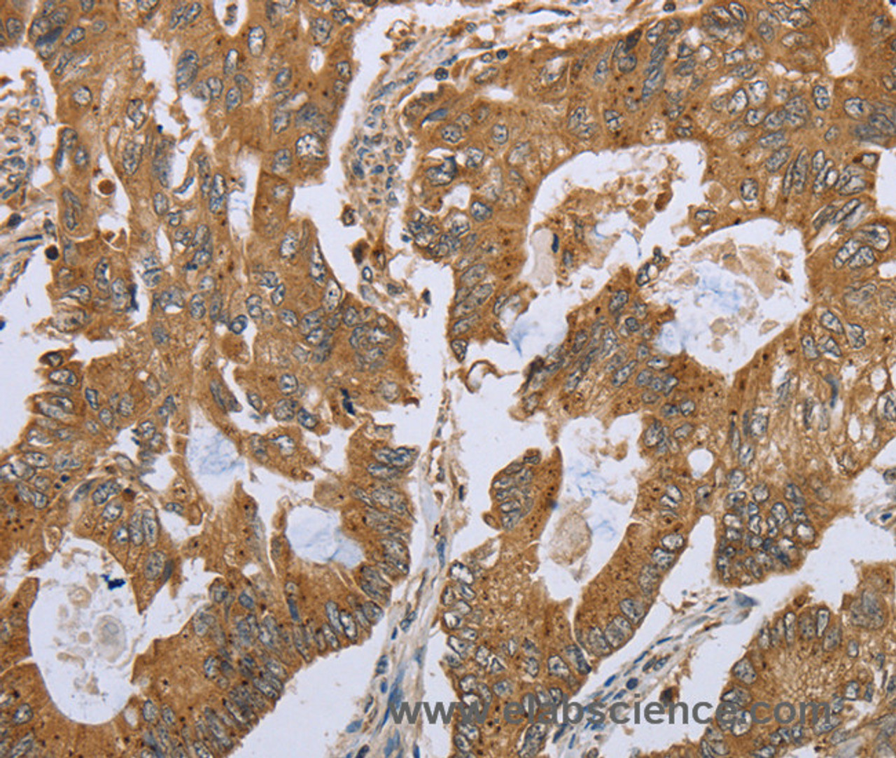 Immunohistochemistry of paraffin-embedded Human colon cancer tissue using NLRP10 Polyclonal Antibody at dilution 1:45