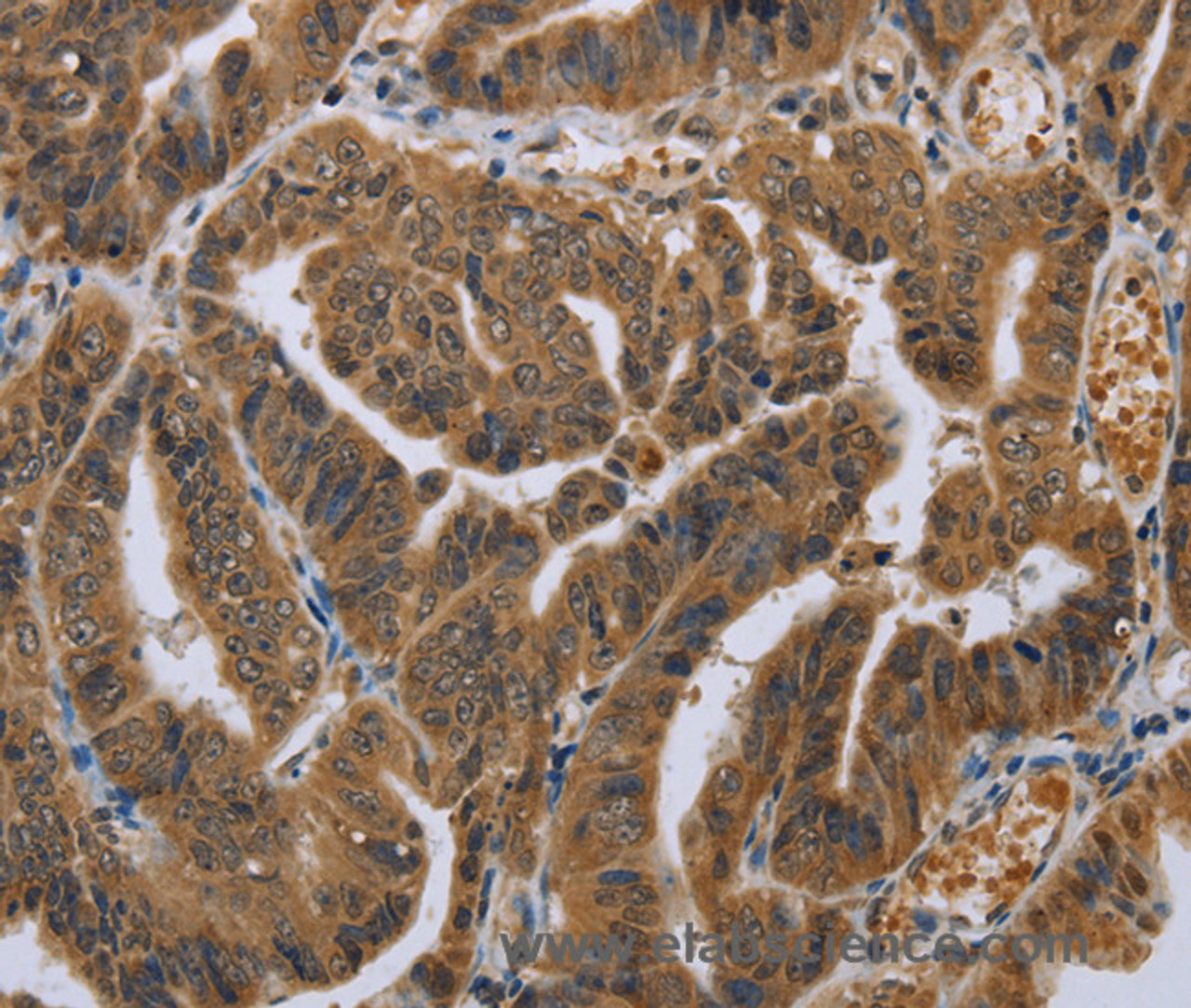 Immunohistochemistry of paraffin-embedded Human gastric cancer tissue using NLRP10 Polyclonal Antibody at dilution 1:45