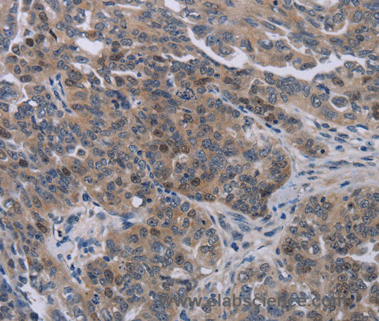 Immunohistochemistry of paraffin-embedded Human ovarian cancer tissue using NOX1 Polyclonal Antibody at dilution 1:50