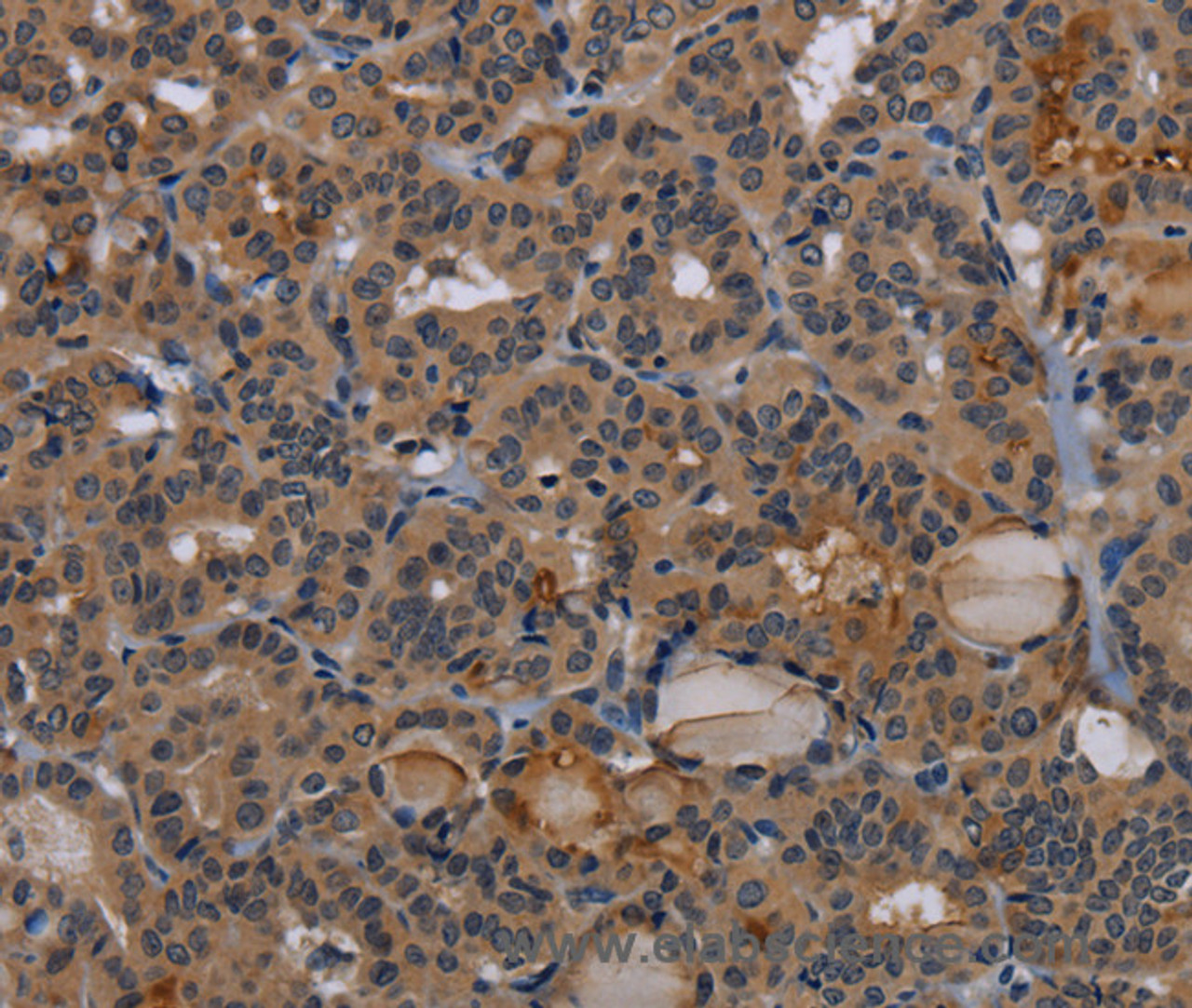 Immunohistochemistry of paraffin-embedded Human thyroid cancer tissue using NPRL2 Polyclonal Antibody at dilution 1:50