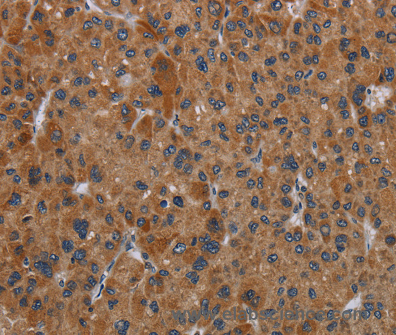 Immunohistochemistry of paraffin-embedded Human liver cancer tissue using OMG Polyclonal Antibody at dilution 1:30