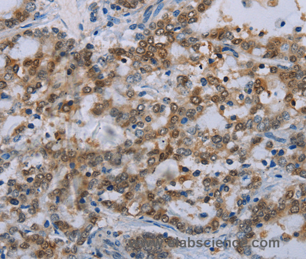 Immunohistochemistry of paraffin-embedded Human liver cancer tissue using MED12 Polyclonal Antibody at dilution 1:40