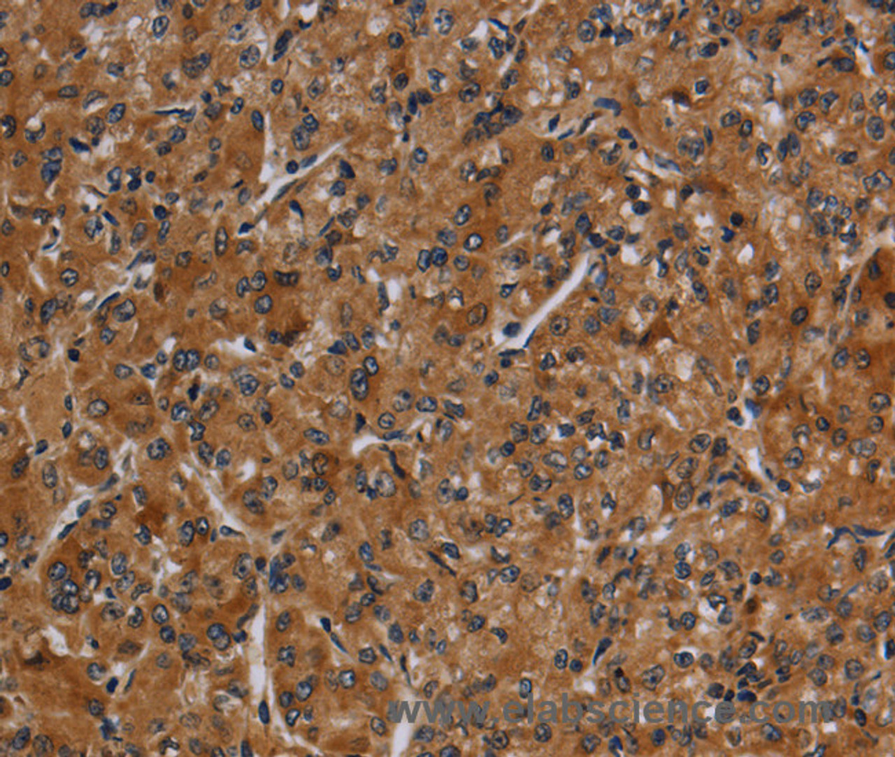 Immunohistochemistry of paraffin-embedded Human prostate cancer using CYP1A2 Polyclonal Antibody at dilution of 1:40