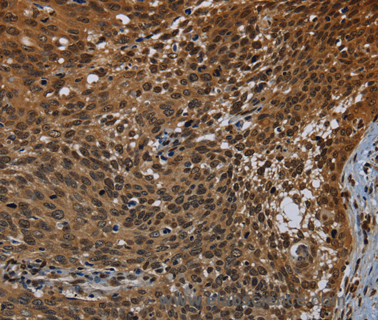 Immunohistochemistry of paraffin-embedded Human cervical cancer tissue using KDM4B Polyclonal Antibody at dilution 1:50