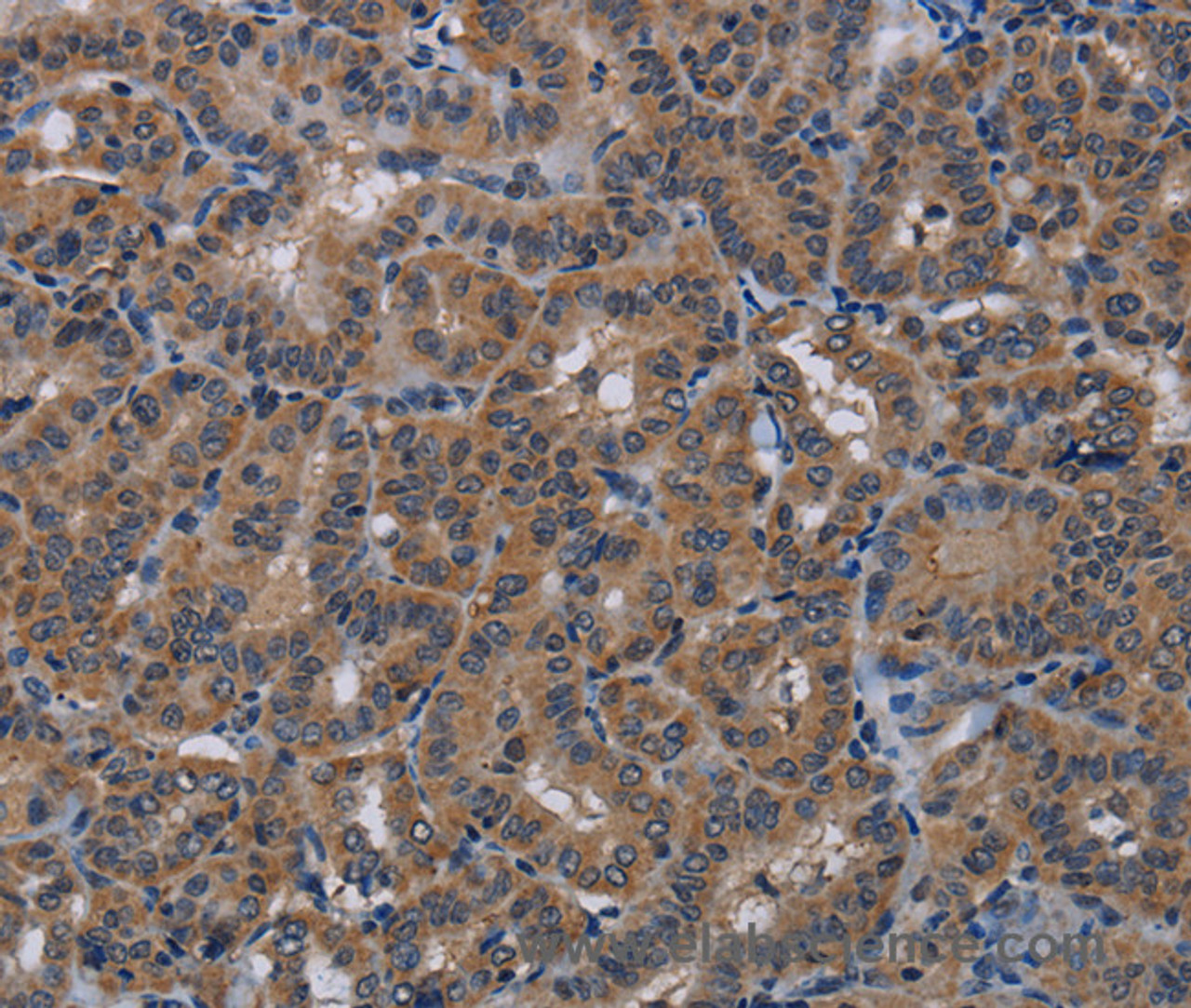 Immunohistochemistry of paraffin-embedded Human thyroid cancer using PDE4A Polyclonal Antibody at dilution of 1:40