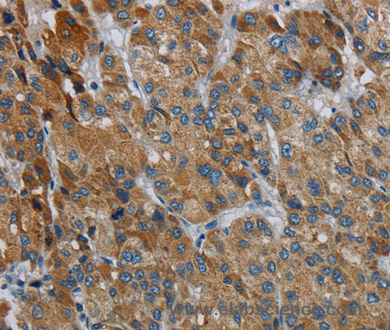 Immunohistochemistry of paraffin-embedded Human liver cancer using PDSS2 Polyclonal Antibody at dilution of 1:30