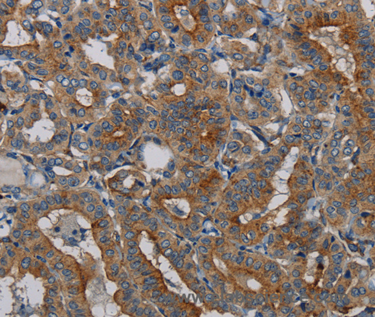 Immunohistochemistry of paraffin-embedded Human thyroid cancer tissue using PER2 Polyclonal Antibody at dilution 1:50