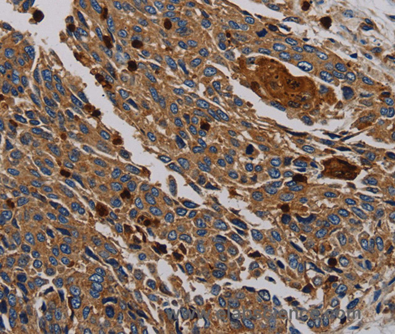 Immunohistochemistry of paraffin-embedded Human lung cancer tissue using PER2 Polyclonal Antibody at dilution 1:50