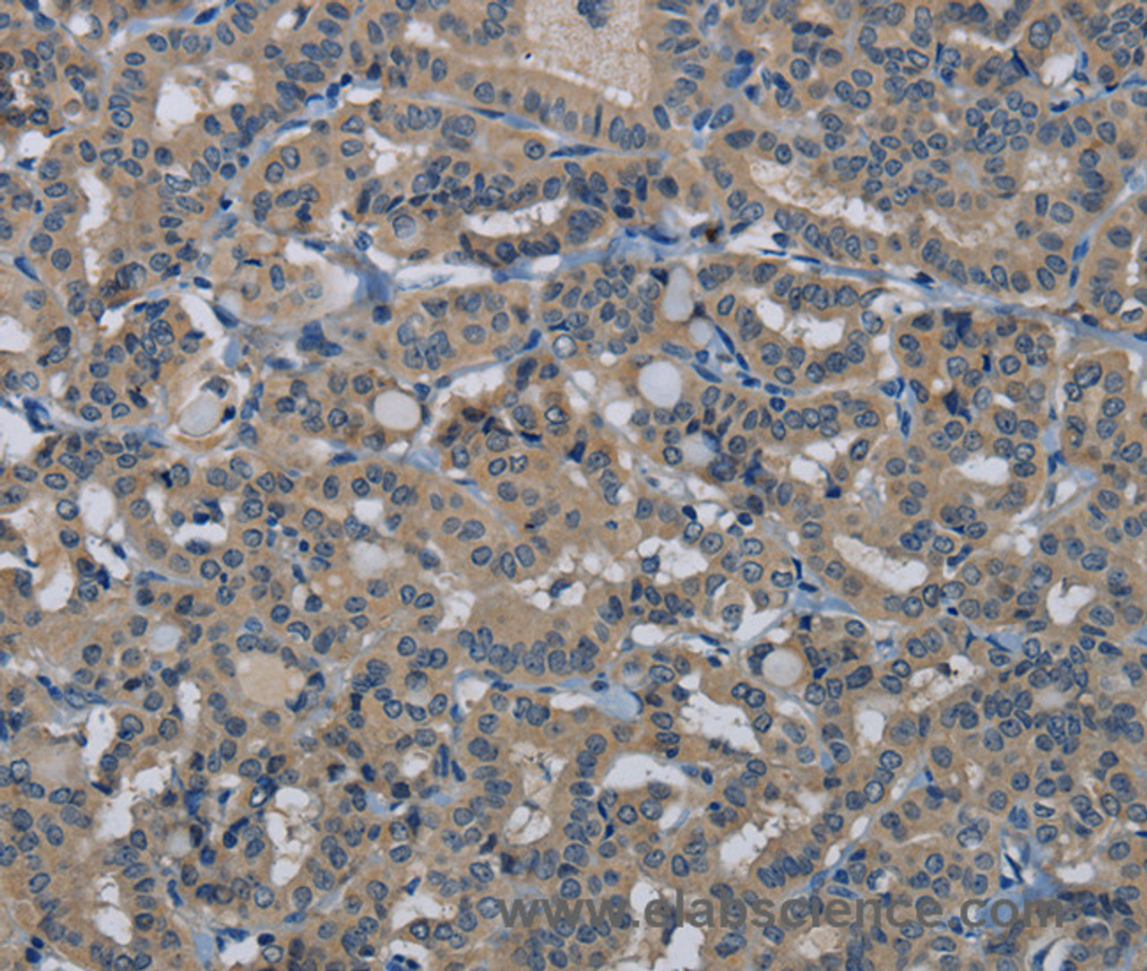 Immunohistochemistry of paraffin-embedded Human thyroid cancer tissue using HSPG2 Polyclonal Antibody at dilution 1:50