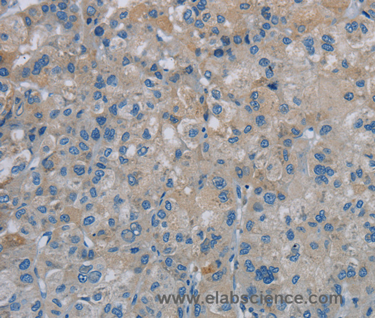Immunohistochemistry of paraffin-embedded Human liver cancer tissue using PGLYRP1 Polyclonal Antibody at dilution 1:40