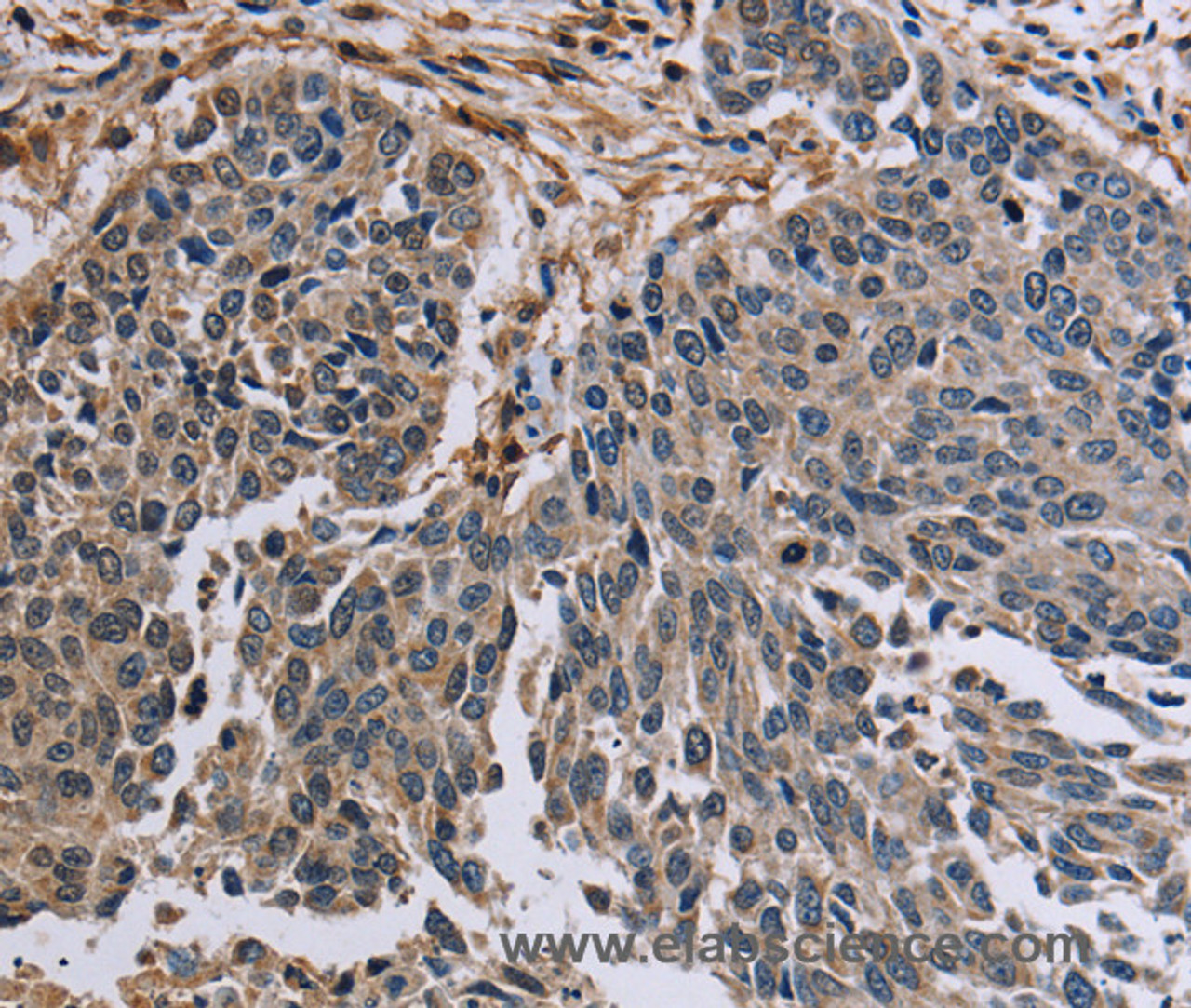 Immunohistochemistry of paraffin-embedded Human lung cancer tissue using PNPT1 Polyclonal Antibody at dilution 1:40