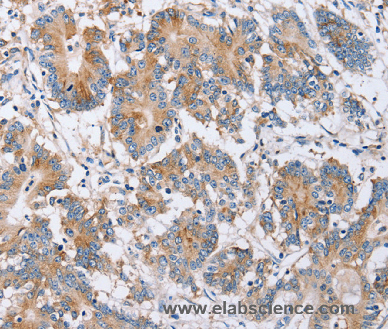 Immunohistochemistry of paraffin-embedded Human colon cancer using PPM1F Polyclonal Antibody at dilution of 1:40