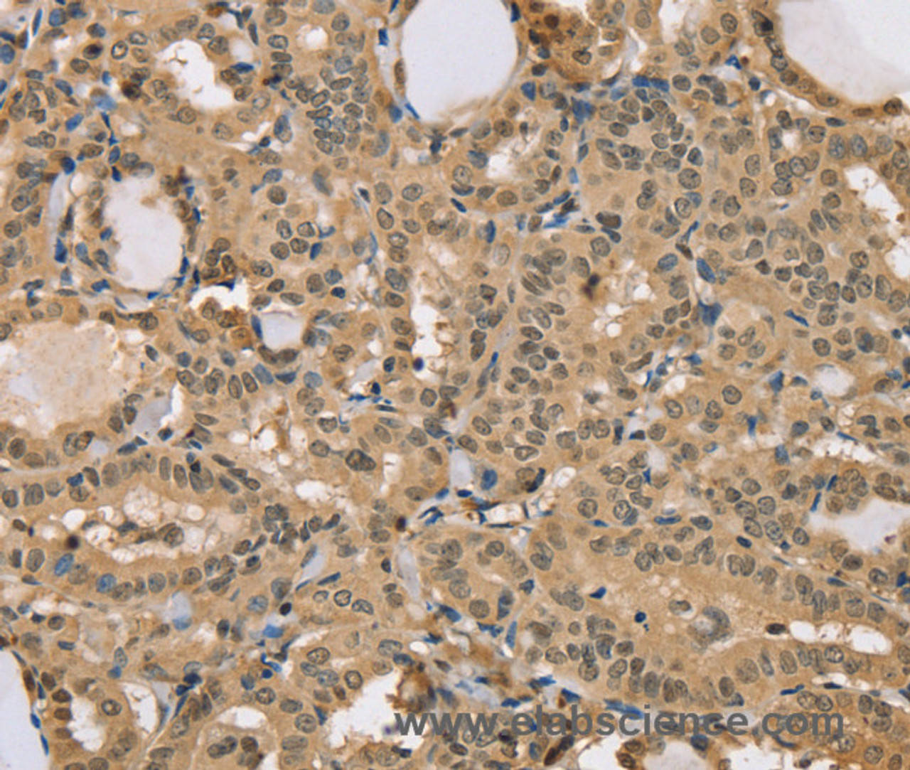 Immunohistochemistry of paraffin-embedded Human thyroid cancer using CENPV Polyclonal Antibody at dilution of 1:40
