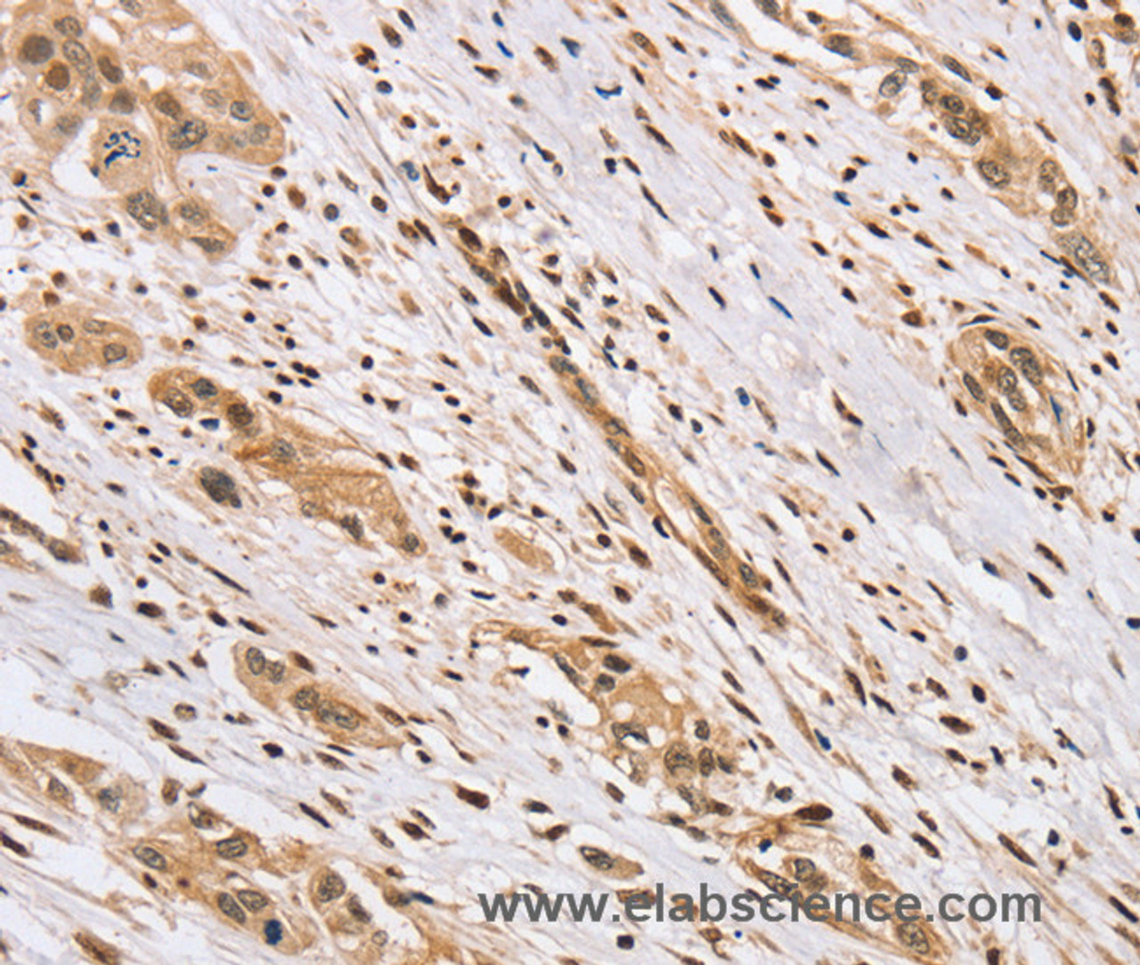 Immunohistochemistry of paraffin-embedded Human esophagus cancer using CENPV Polyclonal Antibody at dilution of 1:40