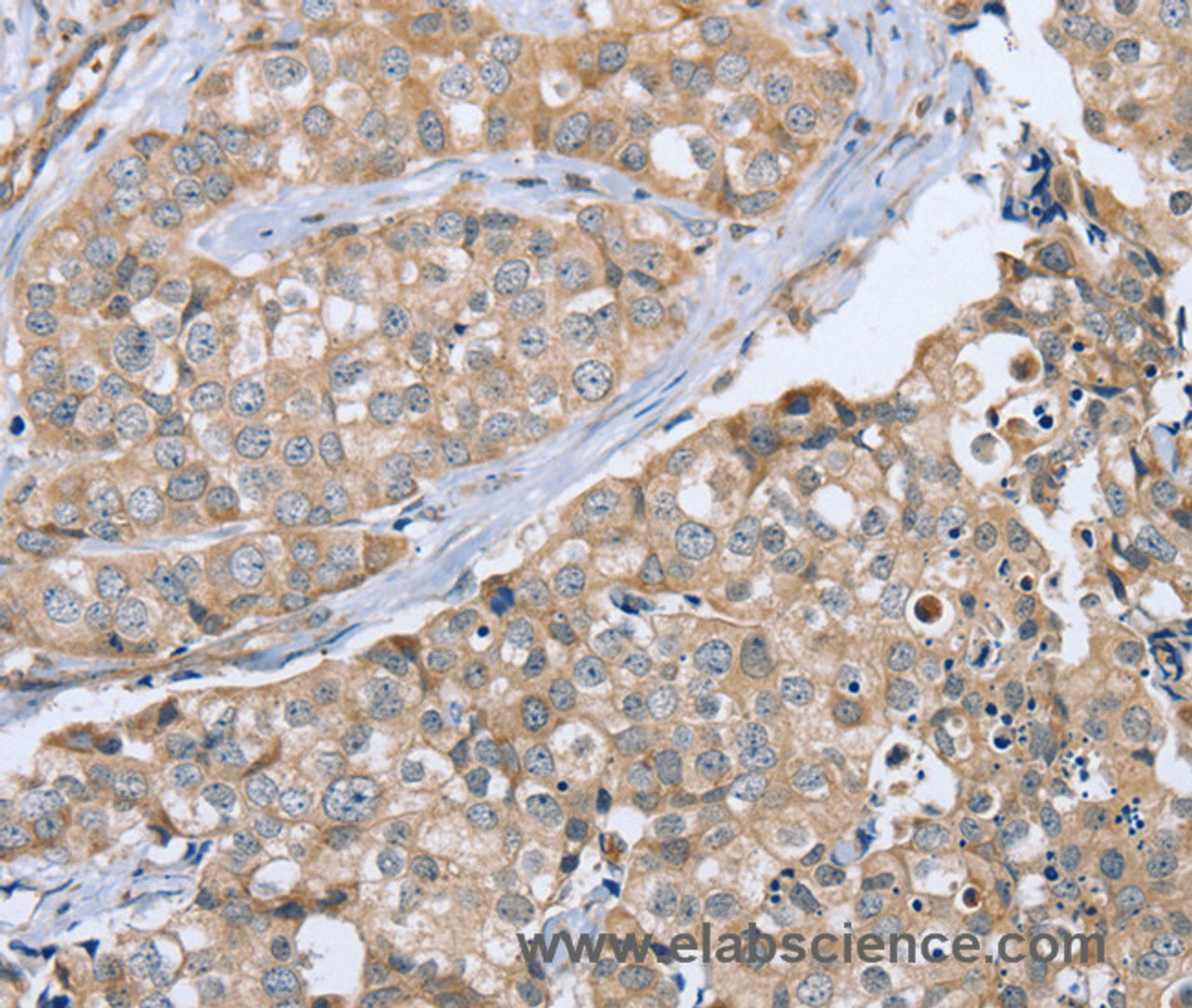 Immunohistochemistry of paraffin-embedded Human breast cancer using CYTH1 Polyclonal Antibody at dilution of 1:40
