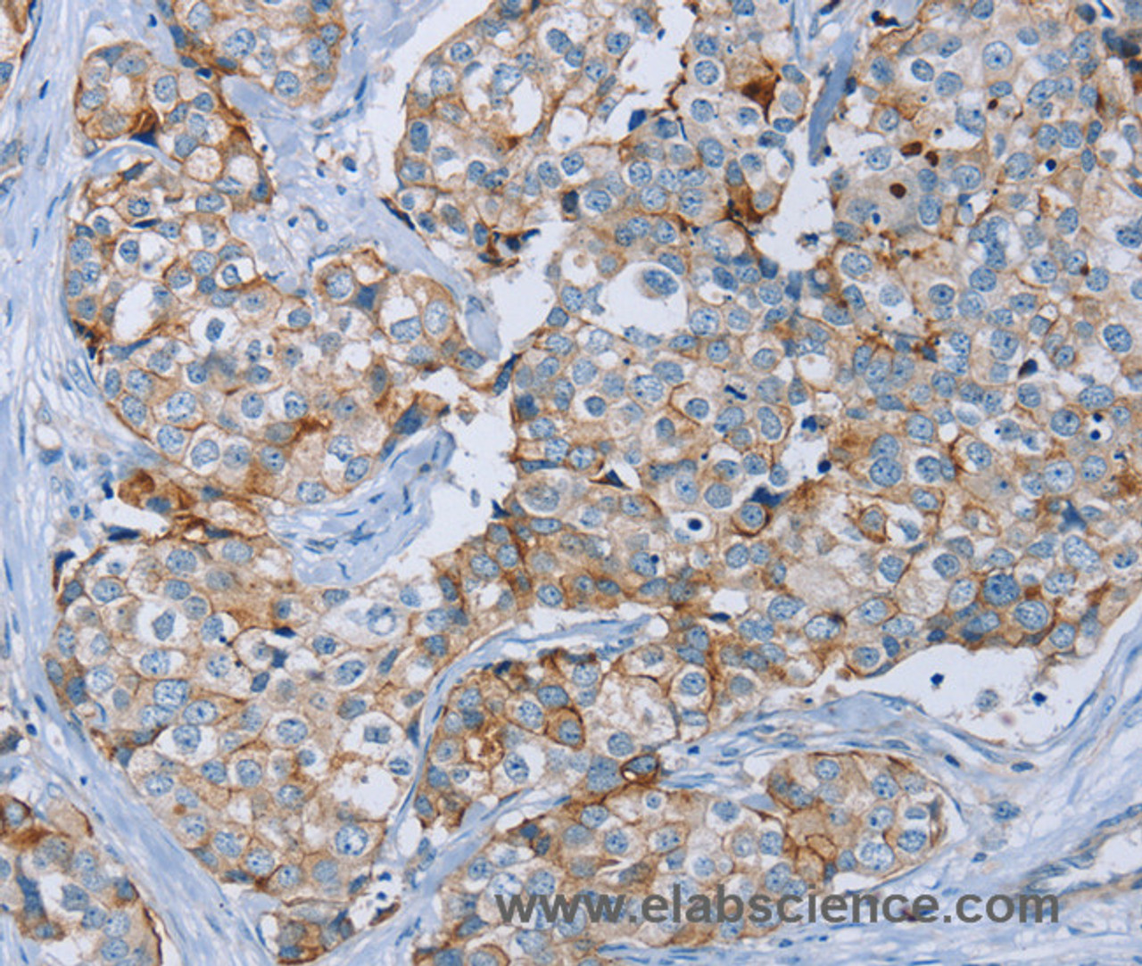 Immunohistochemistry of paraffin-embedded Human breast cancer tissue using MUC1 Polyclonal Antibody at dilution 1:45