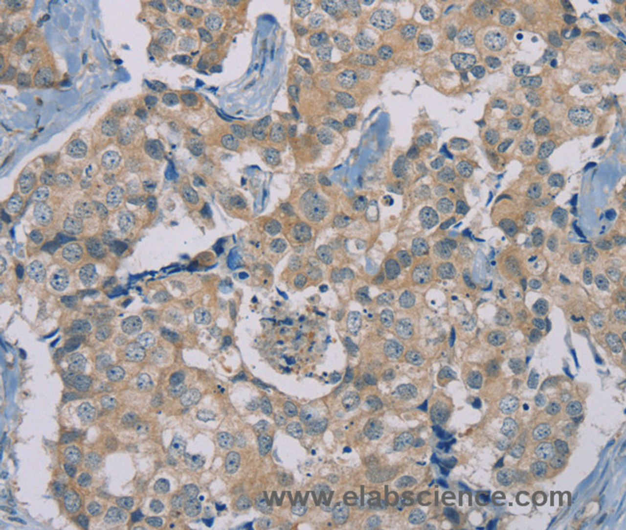 Immunohistochemistry of paraffin-embedded Human breast cancer using RAD51 Polyclonal Antibody at dilution of 1:40
