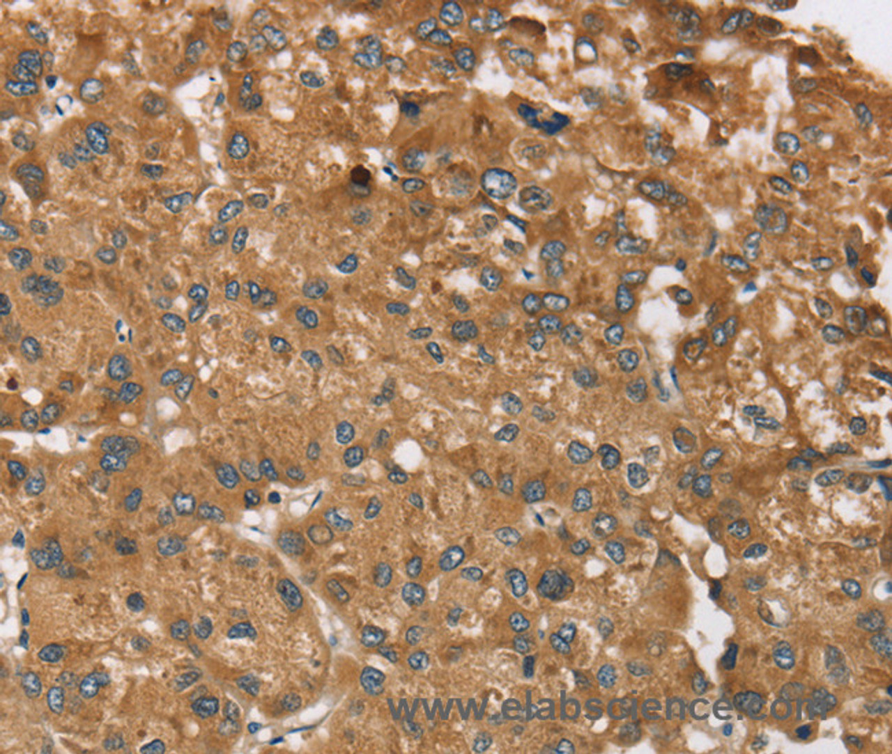 Immunohistochemistry of paraffin-embedded Human liver cancer tissue using RPS6KA2 Polyclonal Antibody at dilution 1:40
