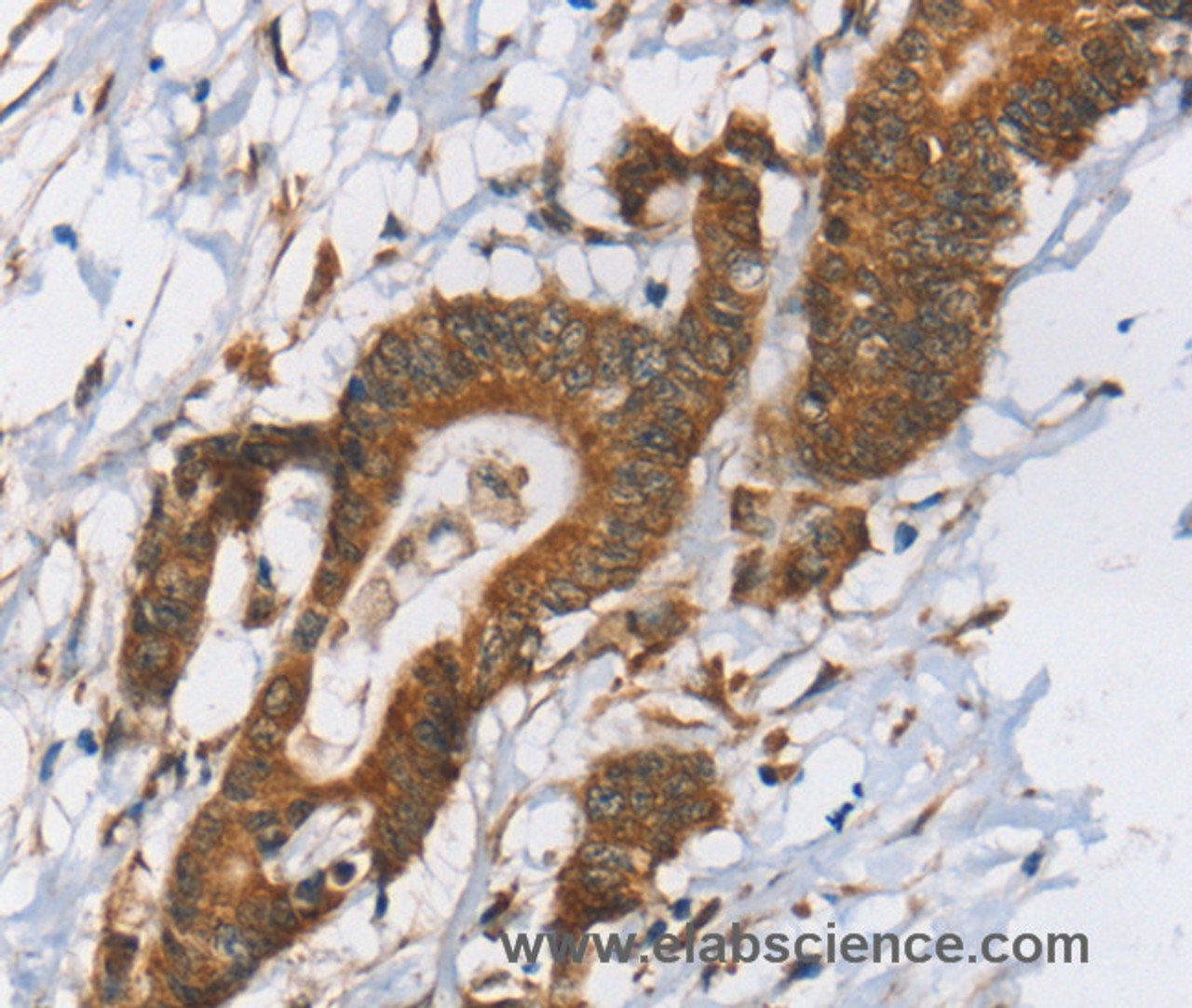 Immunohistochemistry of paraffin-embedded Human colon cancer tissue using RPS6KA2 Polyclonal Antibody at dilution 1:40