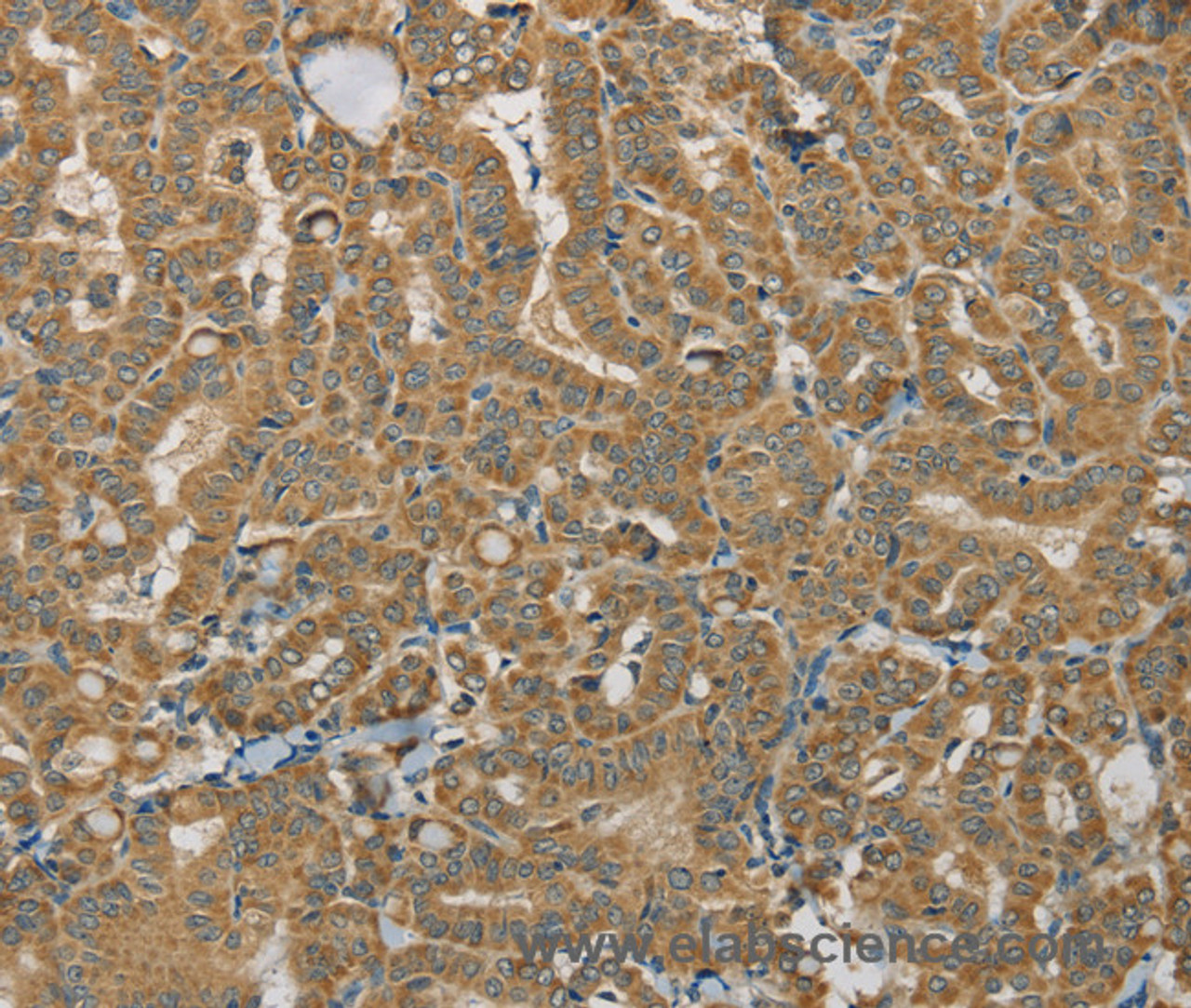 Immunohistochemistry of paraffin-embedded Human thyroid cancer using SDHB Polyclonal Antibody at dilution of 1:30